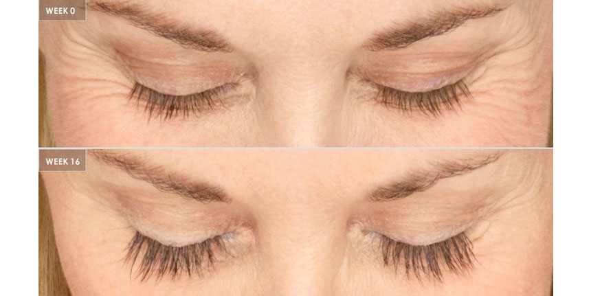 Latisse Eyelash Product | Innovation Dermatology | Red Deer Dermatology & Med Spa Clinic