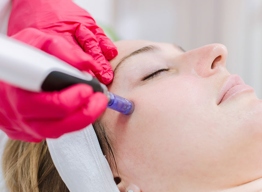 Infini RF Microneedling | Innovation Dermatology | Red Deer Dermatology & Med Spa Clinic