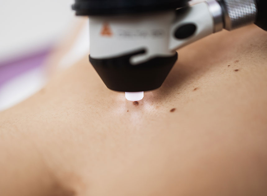 Skin Cancer Surgery | Innovation Dermatology | Red Deer Dermatology & Med Spa Clinic