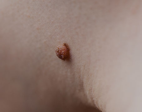 Skin Tag Removal | Innovation Dermatology | Red Deer Dermatology & Med Spa Clinic