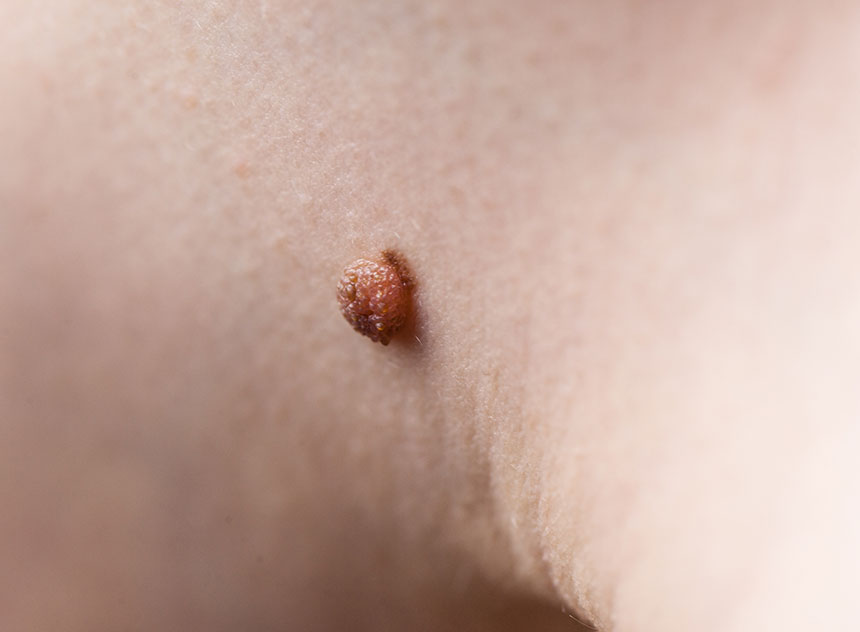 Skin Tag Removal | Innovation Dermatology | Red Deer Dermatology & Med Spa Clinic