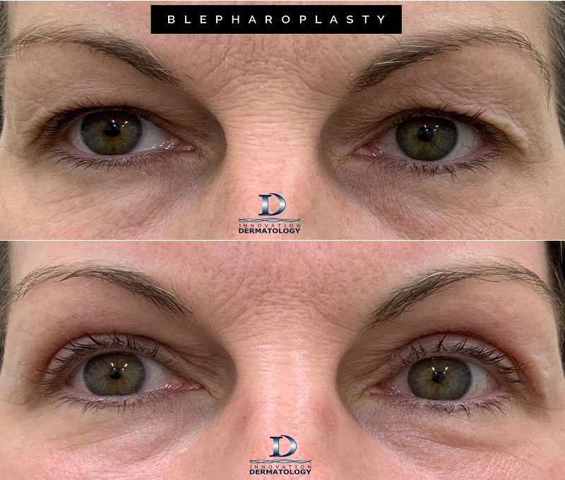 Blepharoplasty Before & After | Innovation Dermatology | Red Deer Dermatology & Med Spa Clinic