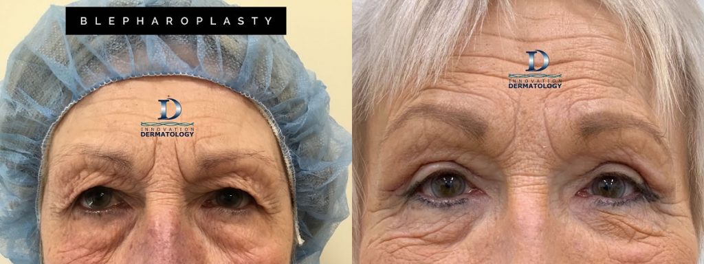 Blepharoplasty Before & After | Innovation Dermatology | Red Deer Dermatology & Med Spa Clinic