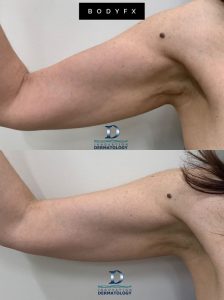 BodyFX Before & After | Innovation Dermatology | Red Deer Dermatology & Med Spa Clinic