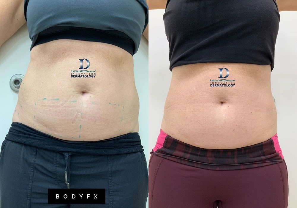 BodyFX Before & After | Innovation Dermatology | Red Deer Dermatology & Med Spa Clinic