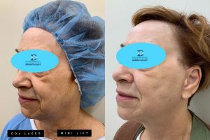 CO2 Laser Mini Lift Before & After | Innovation Dermatology | Red Deer Dermatology & Med Spa Clinic