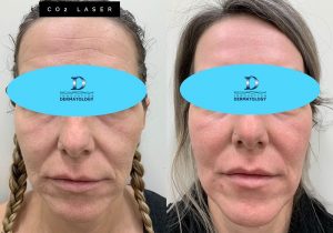 CO2 Laser Before & After | Innovation Dermatology | Red Deer Dermatology & Med Spa Clinic