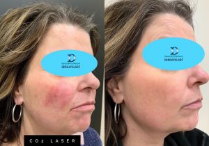 CO2 Laser Before & After | Innovation Dermatology | Red Deer Dermatology & Med Spa Clinic
