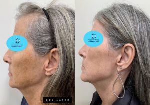 CO2 Laser Before & After | Innovation Dermatology | Red Deer Dermatology & Med Spa Clinic
