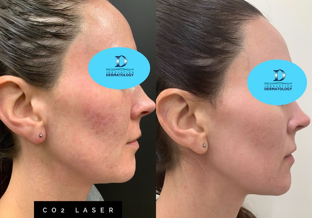 CO2 Laser Before & After | Innovation Dermatology | Red Deer Dermatology & Med Spa Clinic