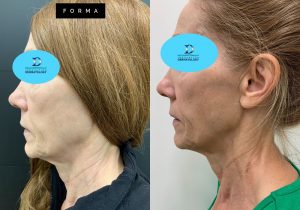 Forma Before & After | Innovation Dermatology | Dermatology and Skin Care in Red Deer