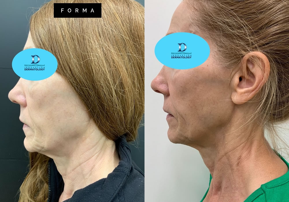 Forma Before & After | Innovation Dermatology | Red Deer Dermatology & Med Spa Clinic