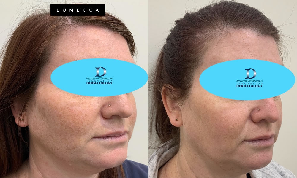 Lumecca Before & After | Innovation Dermatology | Red Deer Dermatology & Med Spa Clinic