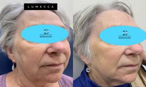 Lumecca Before & After | Innovation Dermatology | Red Deer Dermatology & Med Spa Clinic
