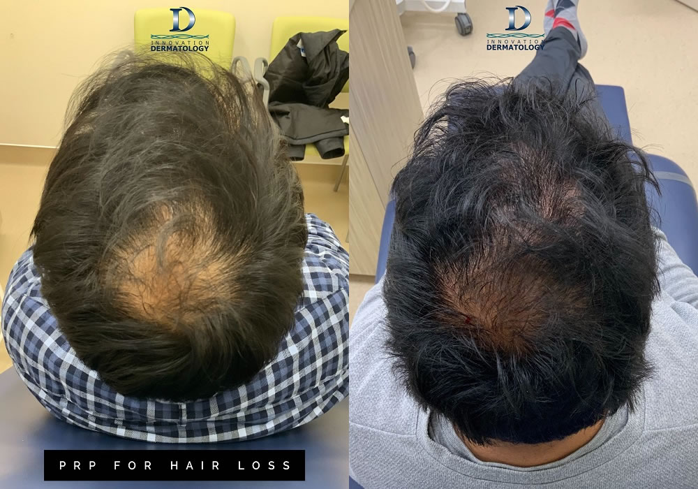 PRT for Hair Loss Before & After | Innovation Dermatology | Red Deer Dermatology & Med Spa Clinic