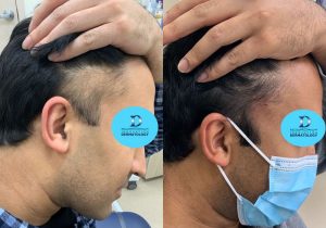 PRT For Hair Loss Before & After | Innovation Dermatology | Red Deer Dermatology & Med Spa Clinic