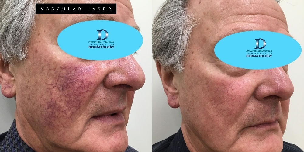 Vascular Laser Before & After | Innovation Dermatology | Red Deer Dermatology & Med Spa Clinic