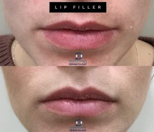 Lip Filler Before & After | Innovation Dermatology | Red Deer Dermatology & Med Spa Clinic