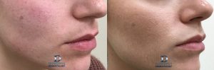 Lip Filler Before & After | Innovation Dermatology | Red Deer Dermatology & Med Spa Clinic