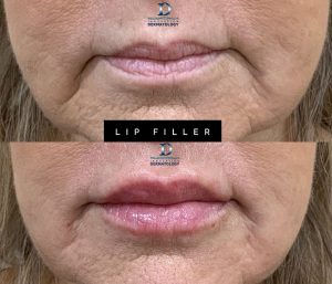 Lip Filler Before & After | Innovation Dermatology | Red Deer Dermatology & Med Spa Clinic