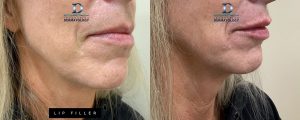 Lip Filler Before & After | Innovation Dermatology | Red Deer Dermatology & Med Spa Clinic