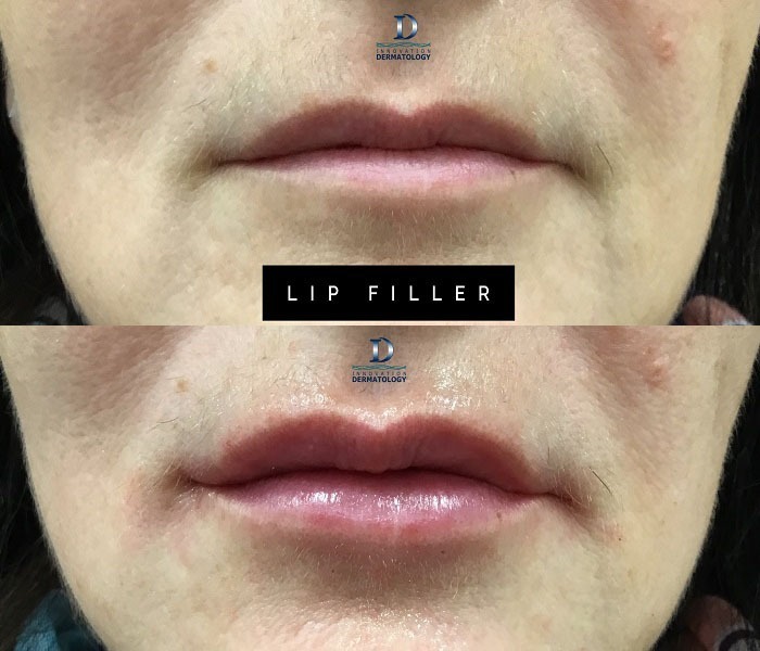 Lip Filler Before & After | Innovation Dermatology | Red Deer Dermatology & Med Spa Clinic