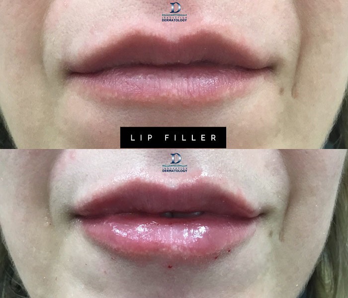 Lip Filler Before & After | Innovation Dermatology | Red Deer Dermatology & Med Spa Clinic